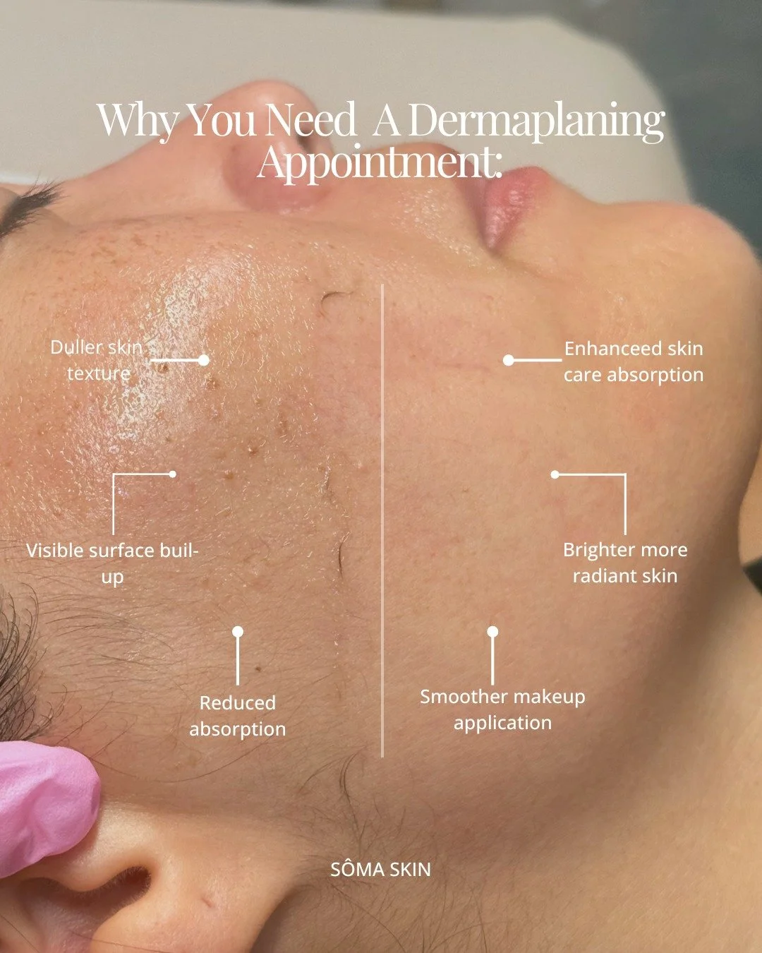 Dermaplaning is so much more than removing peach fuzz.

By removing dead skin cells and surface build-up, dermaplaning leaves the skin instantly smoother, brighter and more refined, while creating the perfect canvas for skincare, makeup and your next