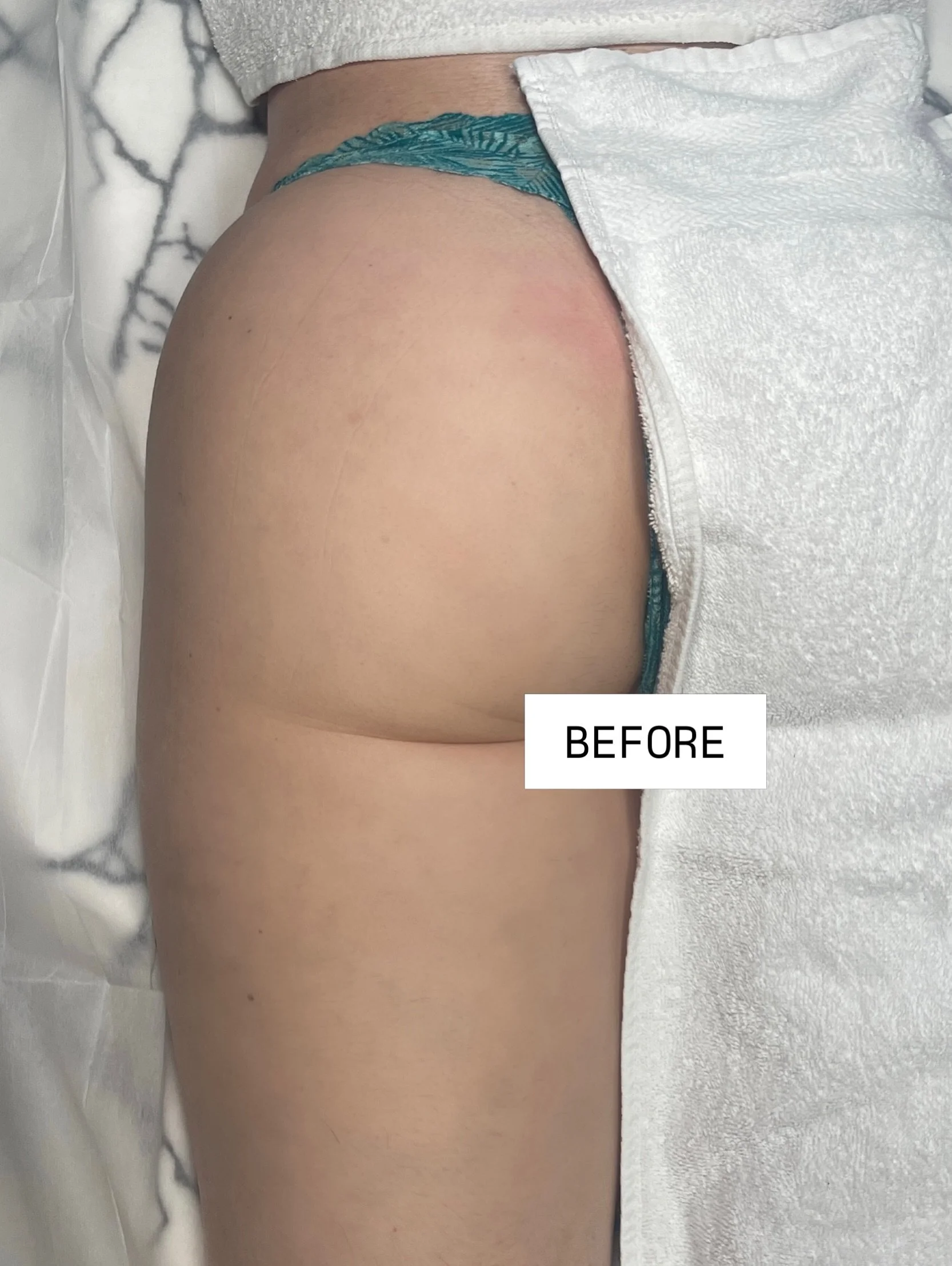 CELLULITE &amp; TIGHTEN TREATMENT ✨

$100 NEW client any treatment 

📍pretty bar miami 

#lymphaticmassage #lymphaticdrainage #bodysculptingmiami #selfcare #prettybar