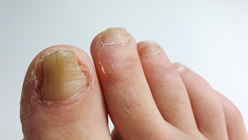 toenail fungus treatment Irwin PA podiatrist