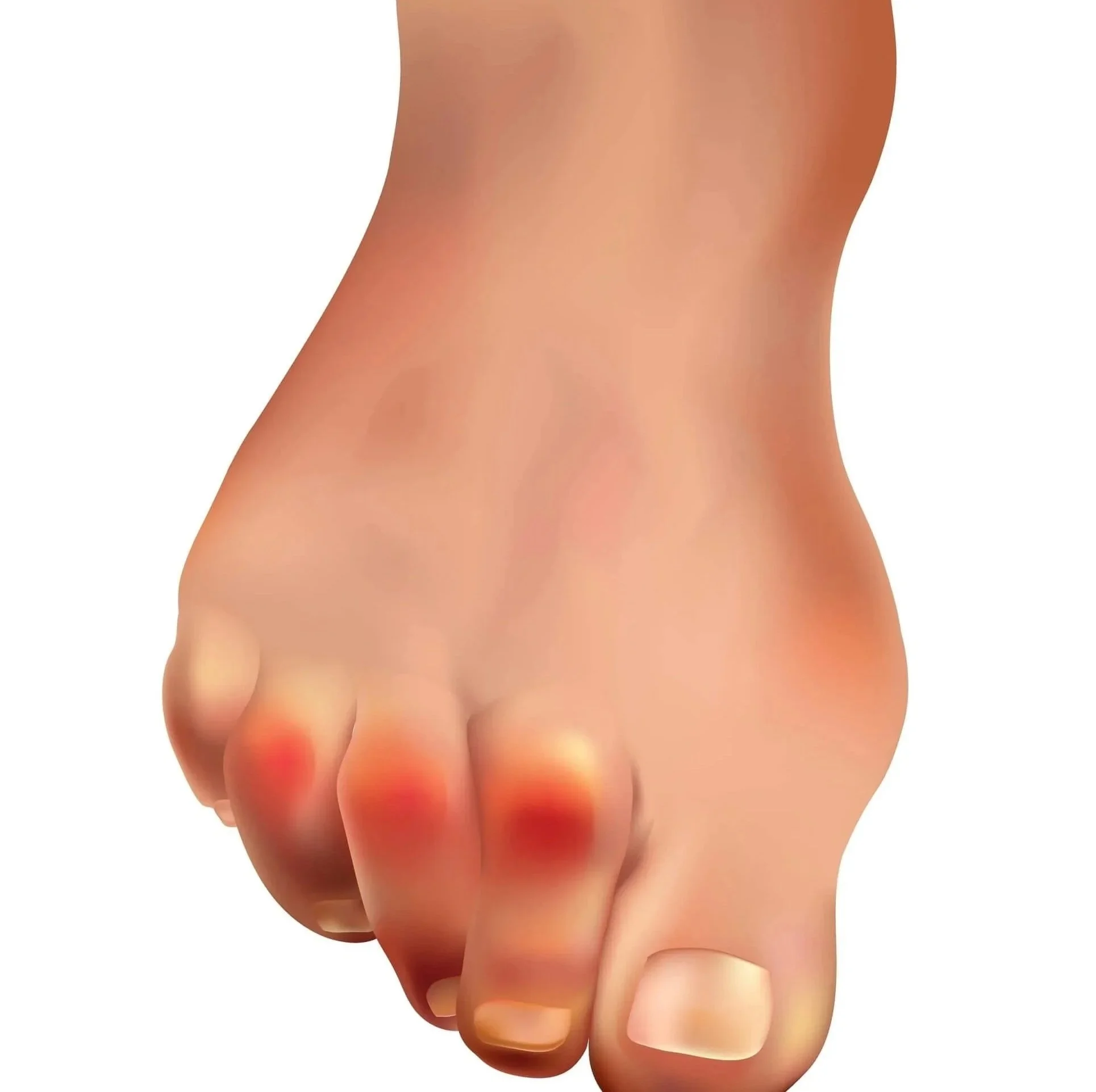 hammertoe treatment and hammertoe correction surgery in Irwin PA