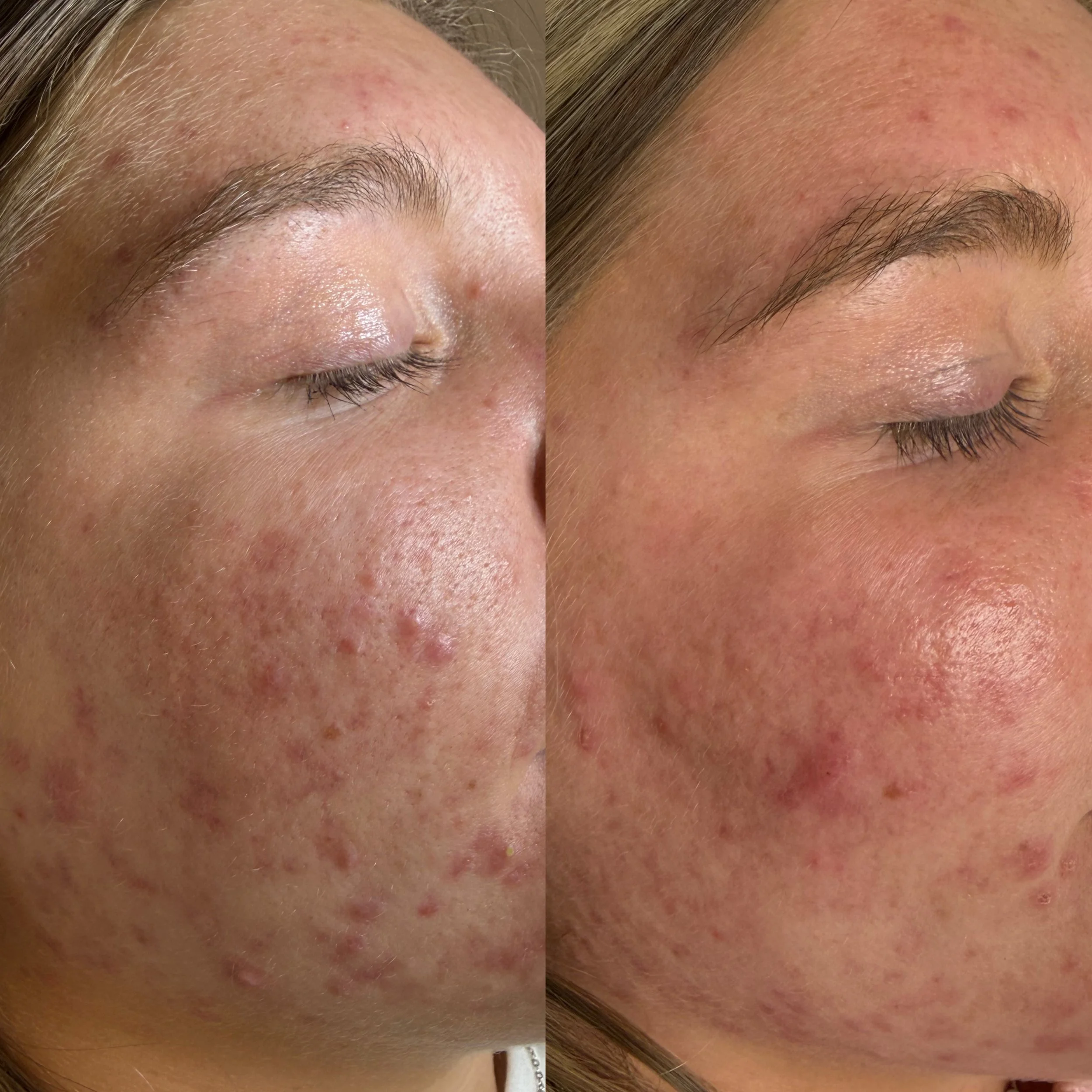 Close-up of a woman’s forehead and eye area showing skin with red acne and blemishes.