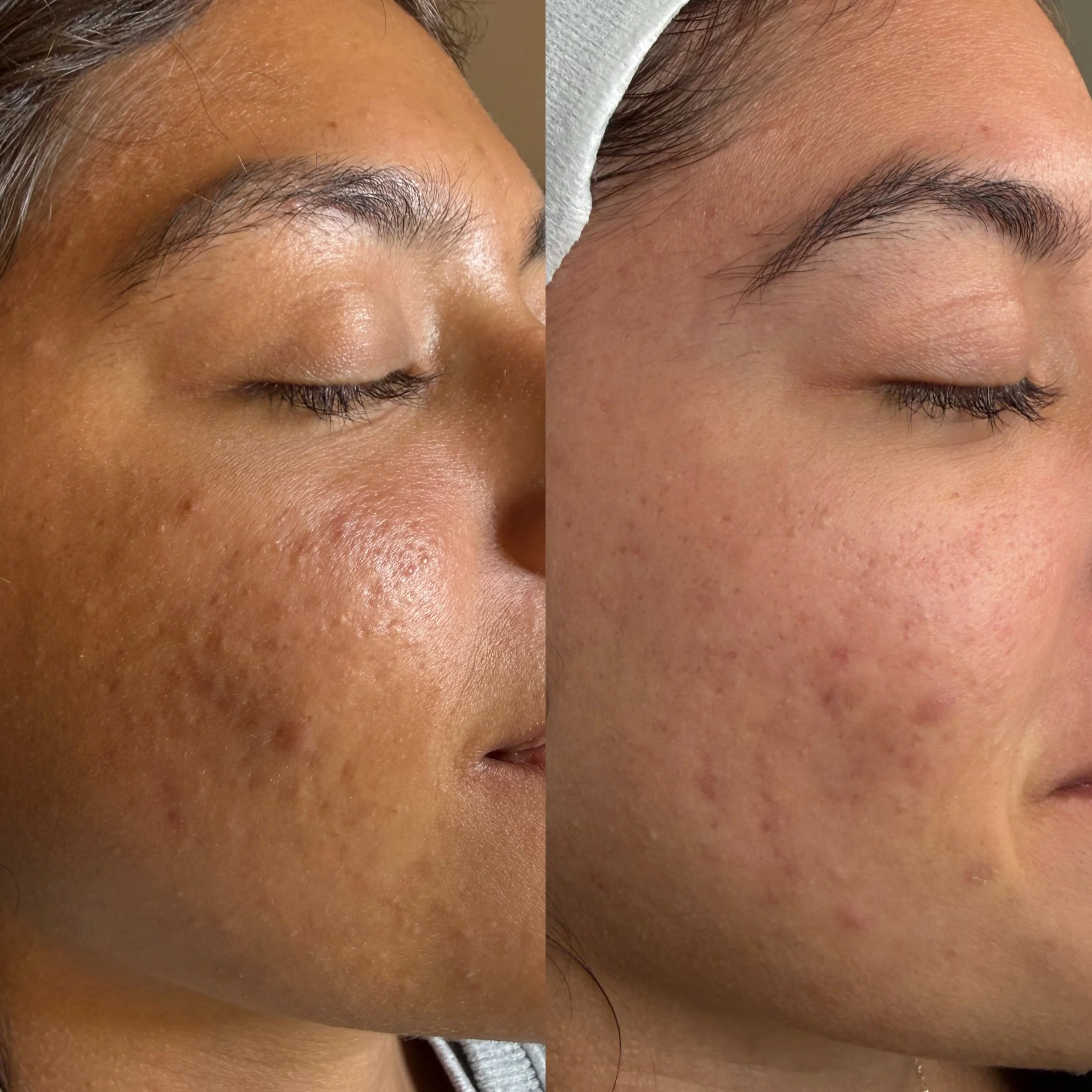 Close-up images of a person's face showing a before and after comparison of skin treatment, focusing on forehead, eyebrows, and cheek area.