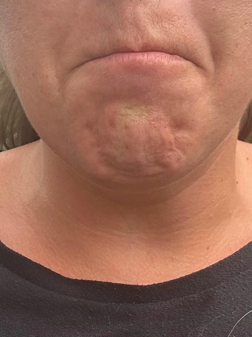 Close-up of a person's chin and mouth showing pebbled chin