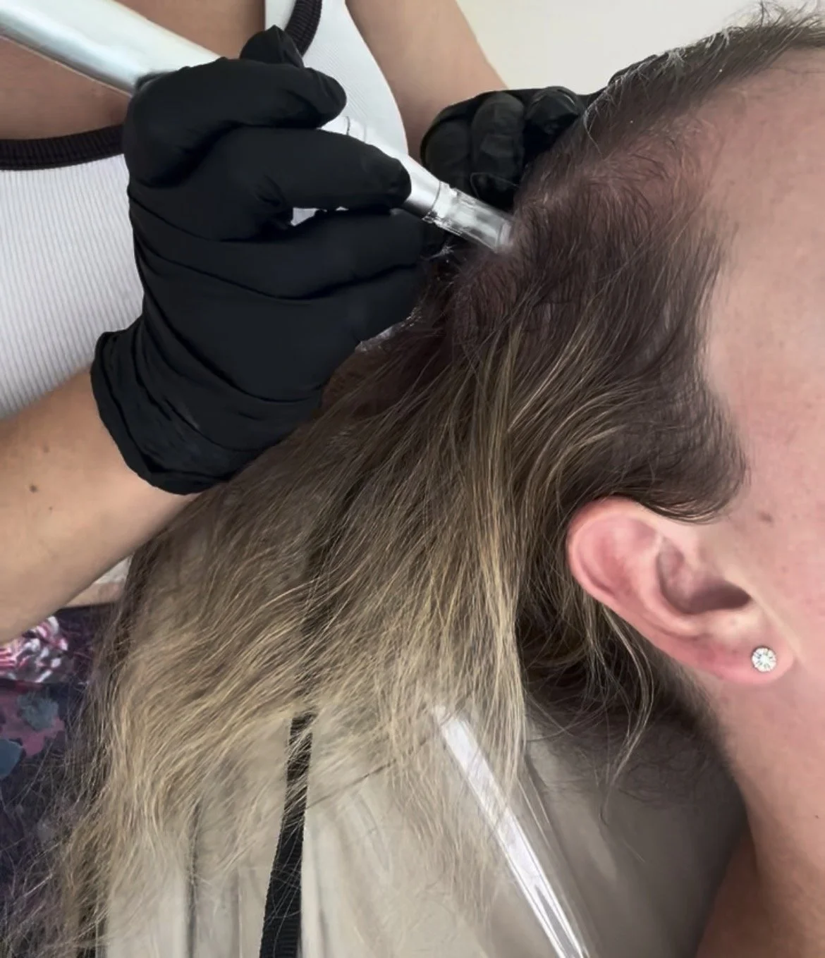 A person receiving a cosmetic procedure on their scalp with a syringe, wearing black gloves, while lying on a white chair.