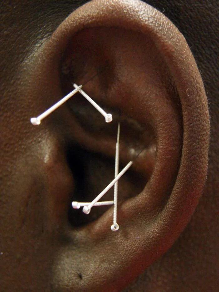 Acupuncture