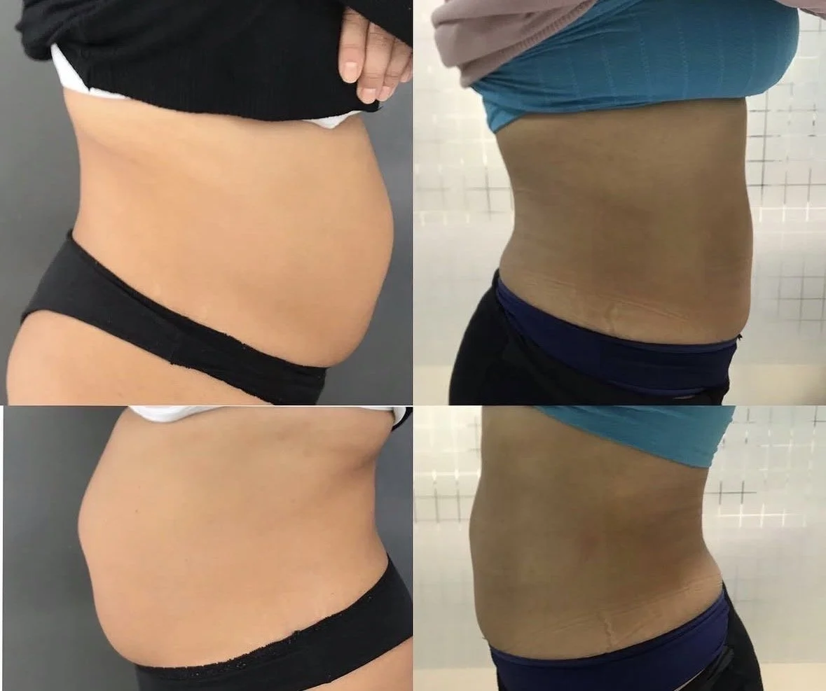CRYOLIPOLYSIS FAT TREATMENT