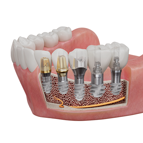 Level 1 Implant Course