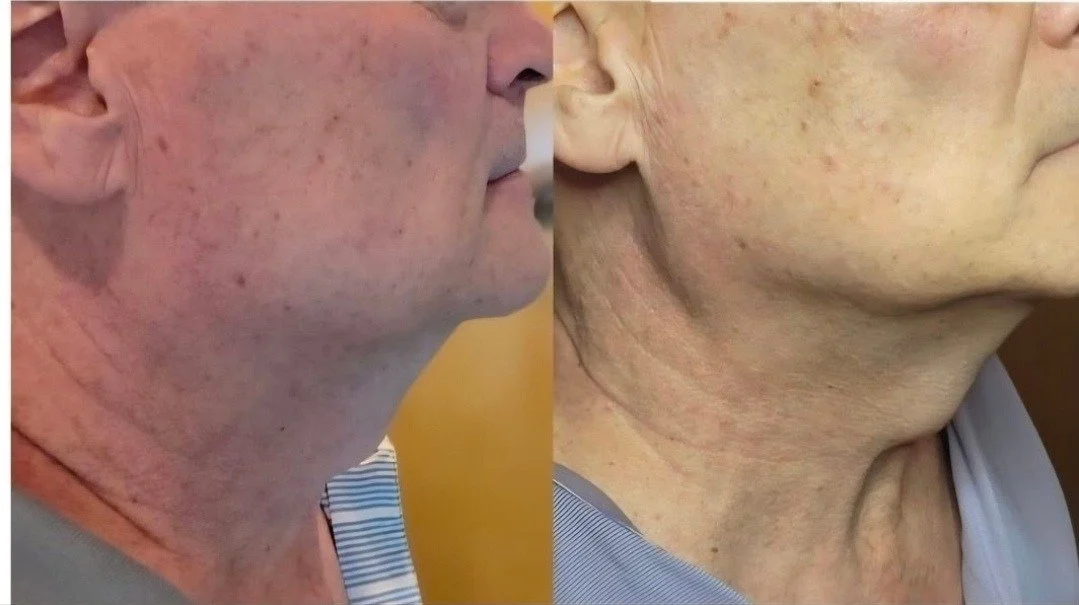 Side-by-side comparison of a person's neck before and after a cosmetic treatment, showing improved skin texture and reduced wrinkles on the right.