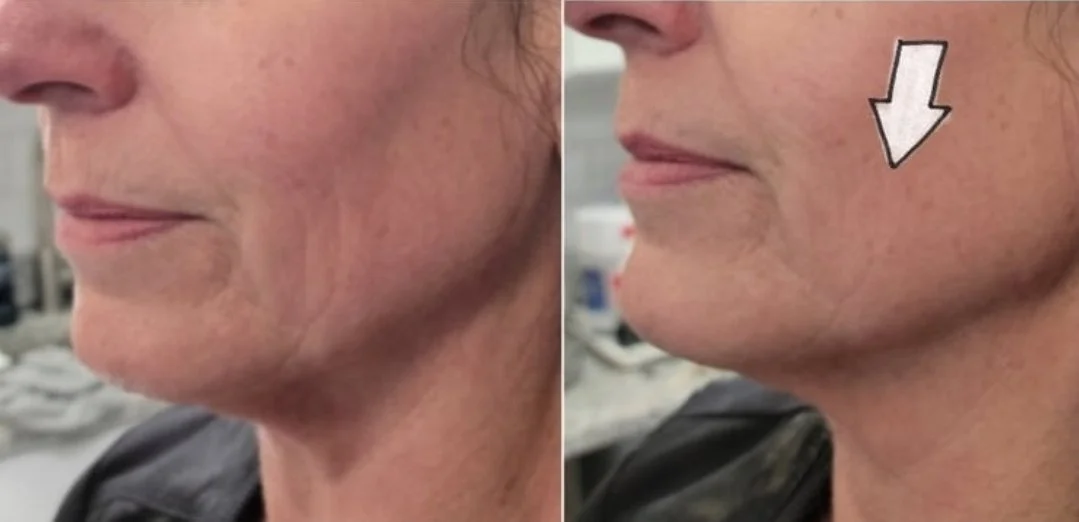 DualHi HIFU Face Lifting Treatment Results