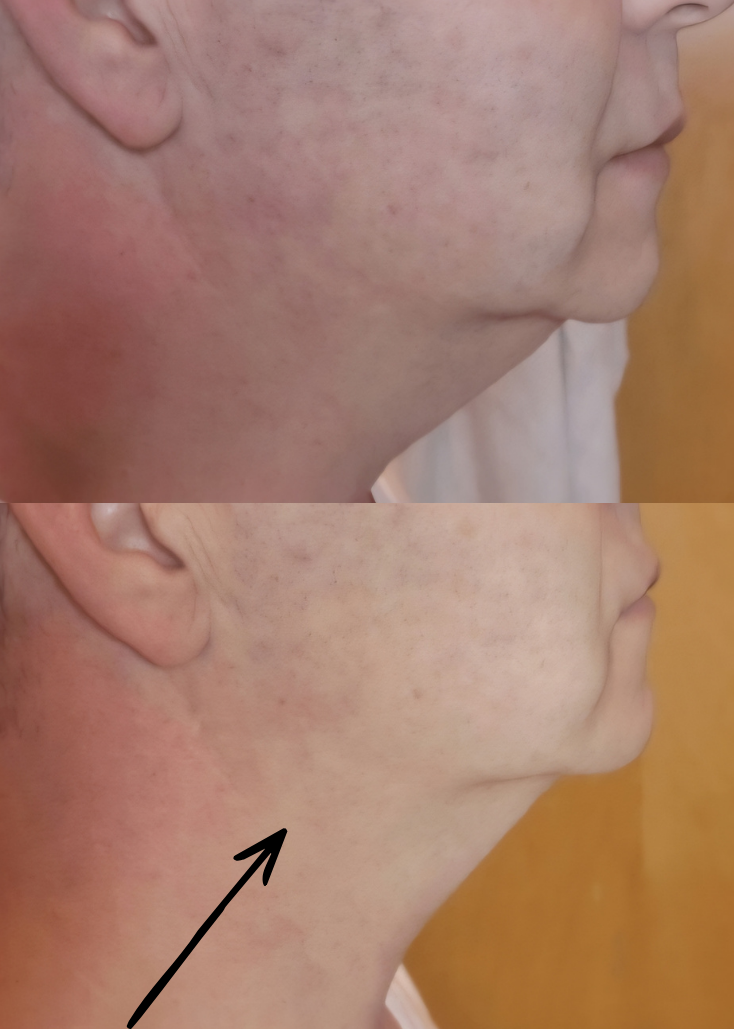 Side-by-side comparison of a person's chin and jawline before and after treatment, showing reduced acne scars and improved skin texture in the after image.