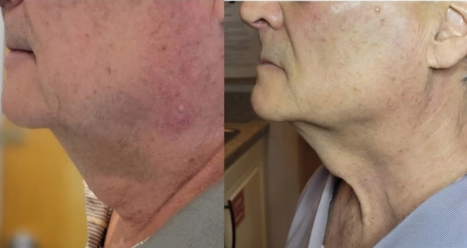 Comparison of a person's skin before and after treatment, showing significant reduction in redness, blemishes, and signs of aging.
