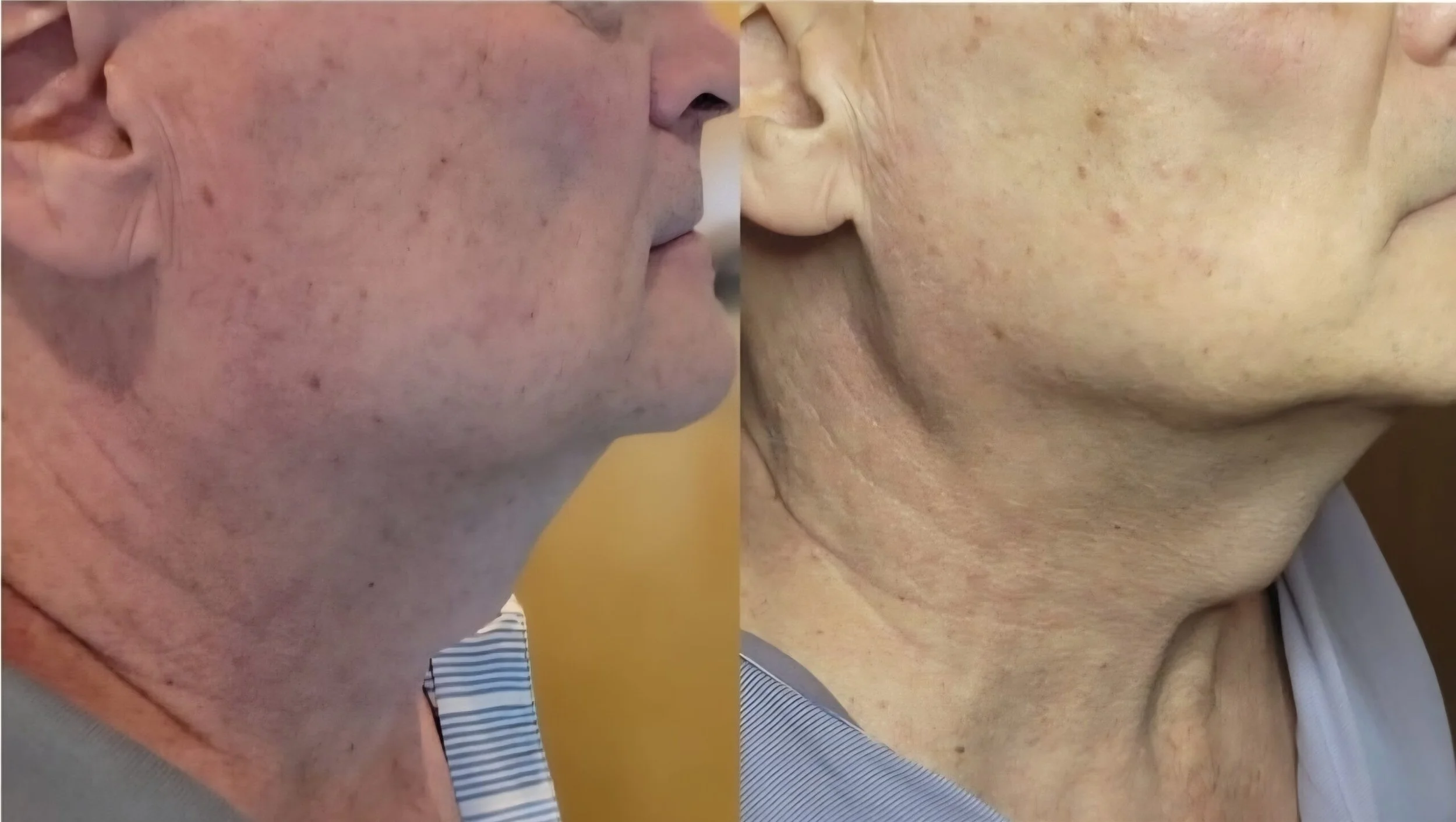 Anti Aging HIFU Mens Neck Service