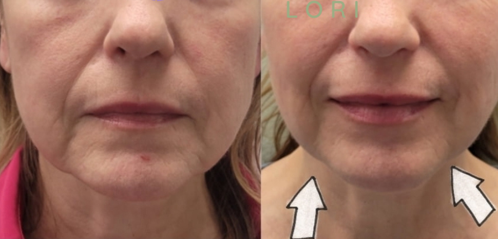 HIFU Face Lifting Treatment in Charlotte NC