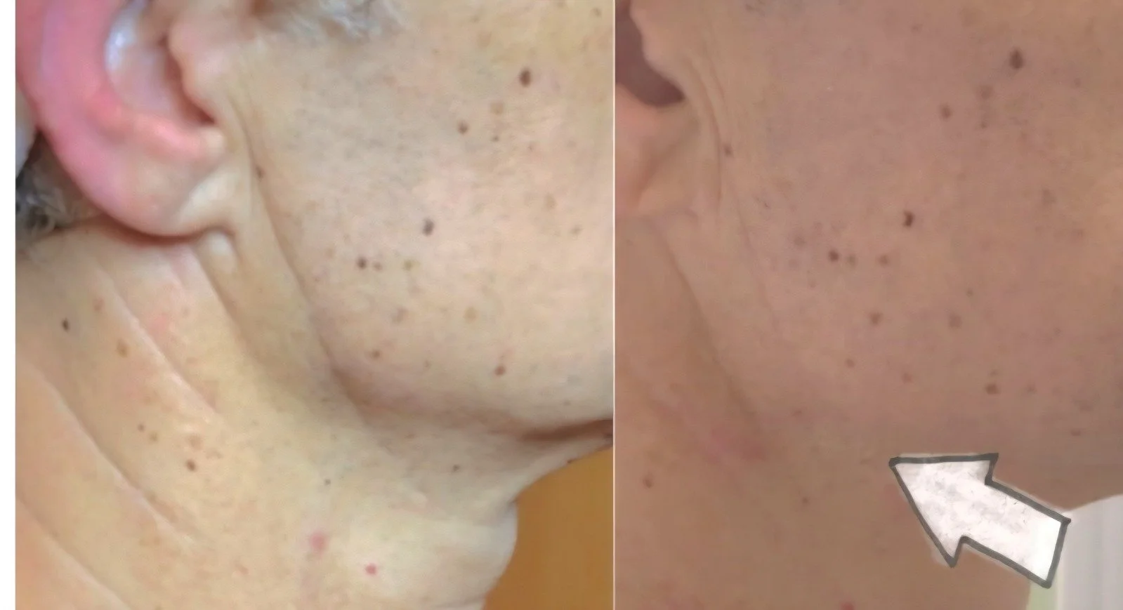 Close-up side view of a person's face with multiple dark spots and freckles, with an arrow pointing to a specific area of the cheek showing the spots.