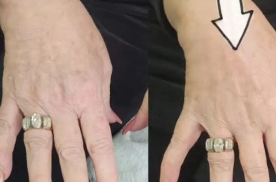 HIFU Anti Aging Hand Treatment in Charlotte NC