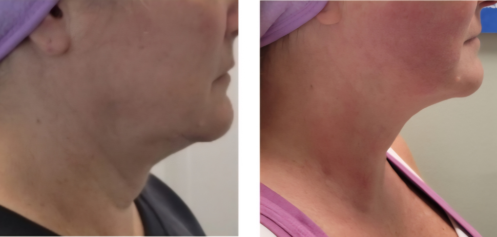 9 Months of Natural Collagen from HIFU Treatment in Charlotte NC