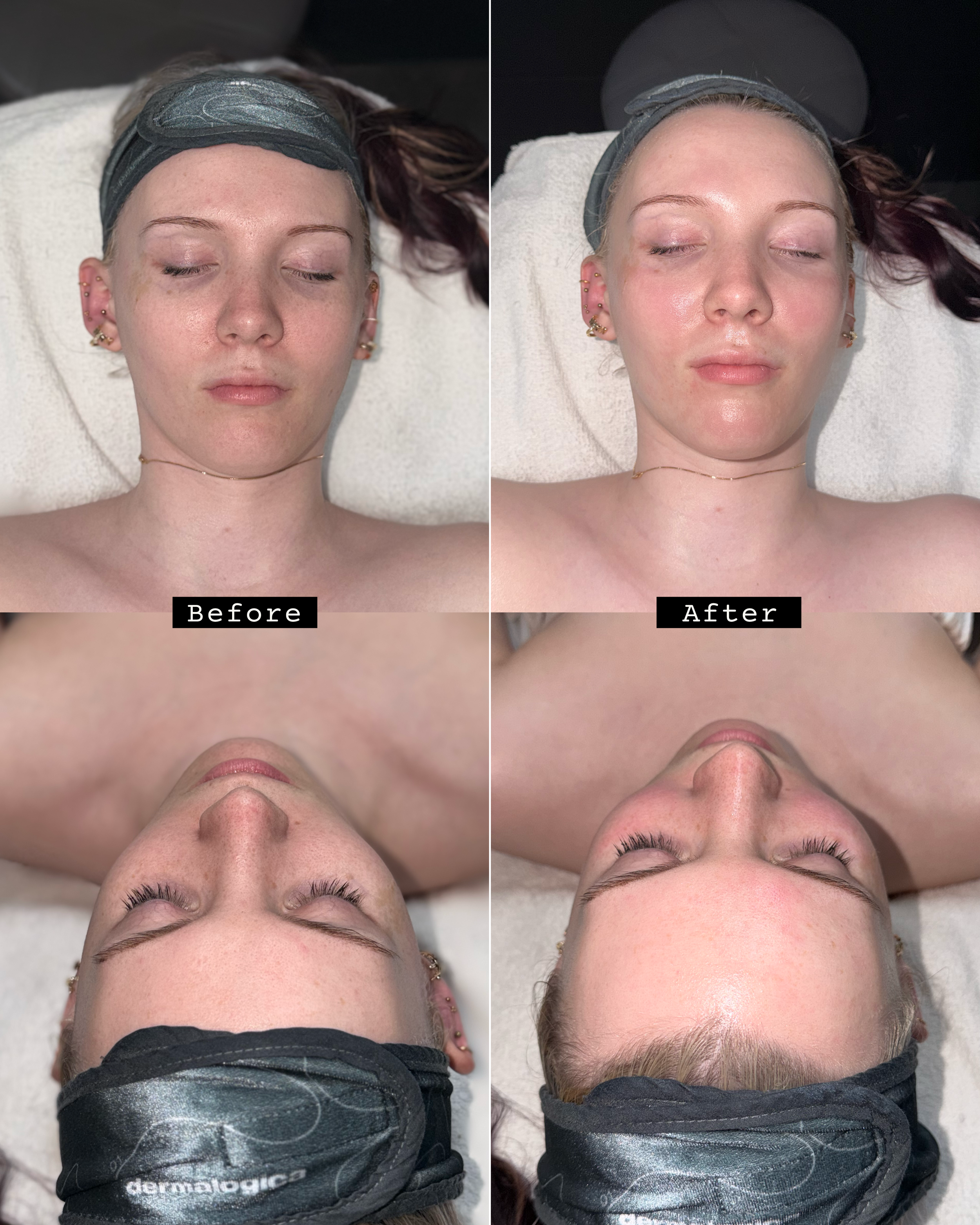 Incredible peel for Payton while I was in esthetics school :)
