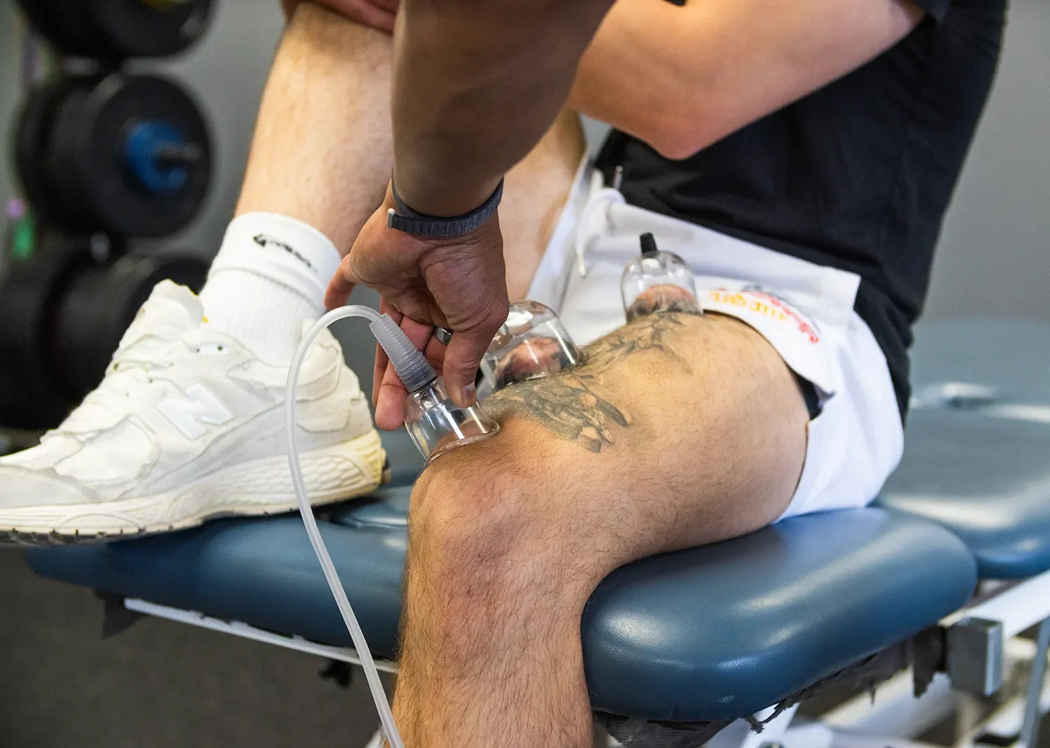 Person receiving cupping therapy on their thigh, with multiple glass cups placed on the skin, in a gym or therapy setting.