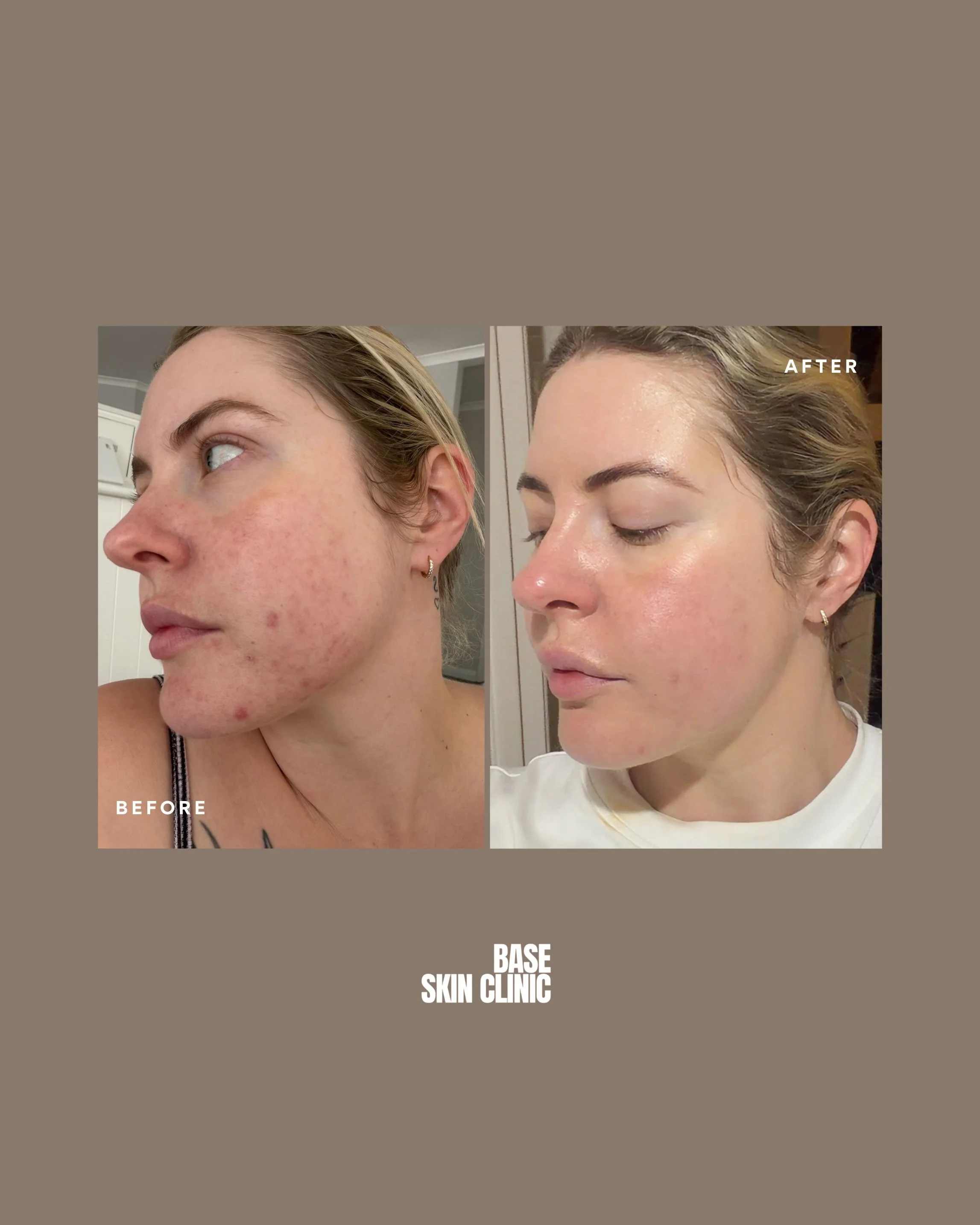 Side-by-side before and after photos of a woman's face showing skin improvement at Base Skin Clinic