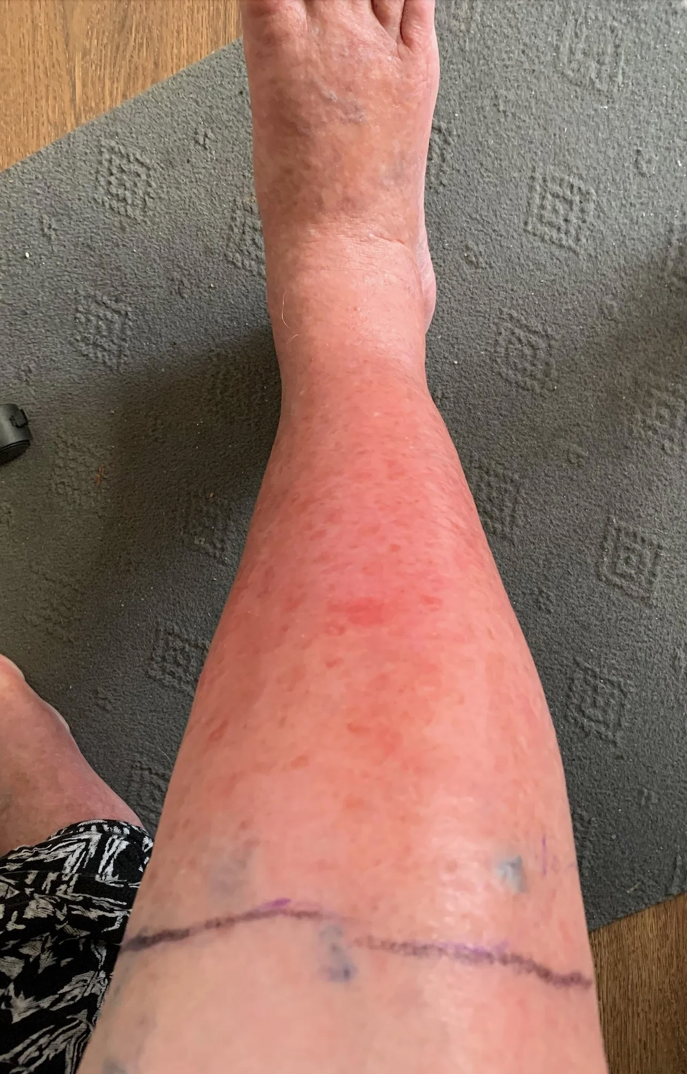 Cellulitis