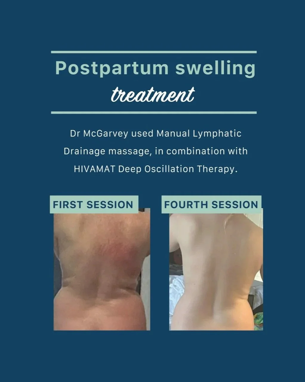 Postpartum swelling