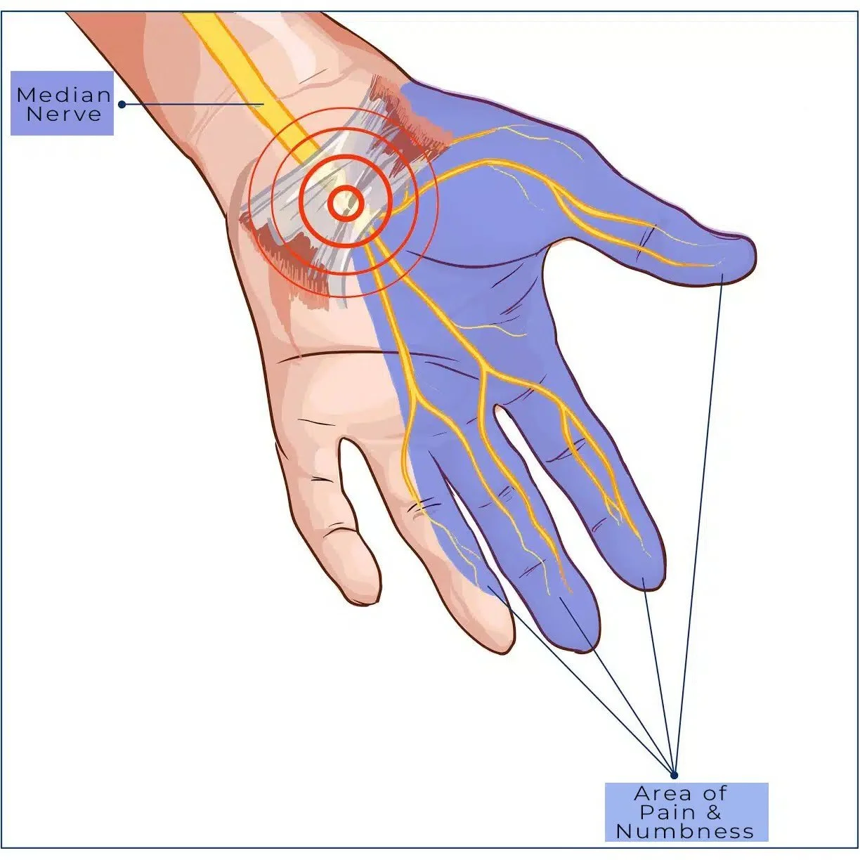 Carpal-Tunnel.jpg