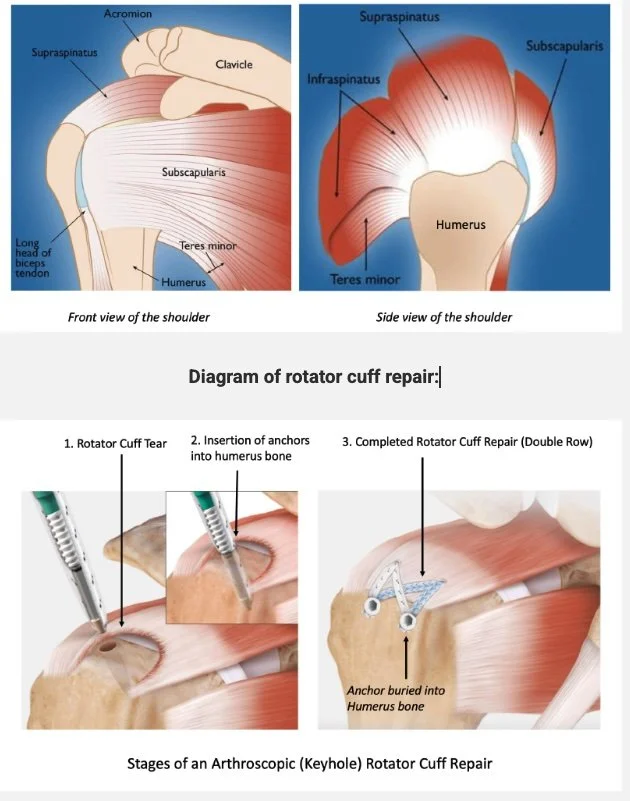 Diagram showing anatomy of the shoulder with front and side views, highlighting muscles such as the supraspinatus, infraspinatus, subscapularis, teres minor, humerus, clavicle, and acromion. Below, illustrations demonstrate the stages of rotator cuff repair, including cuff tear, insertion of anchors into the humerus, and the completed double-row repair with buried anchors.
