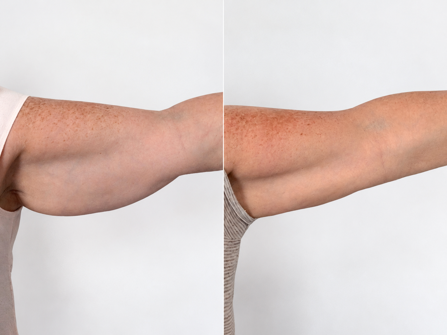 Skin tightening Venus Nova 
