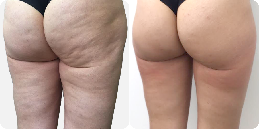 Venus Nova Cellulite 