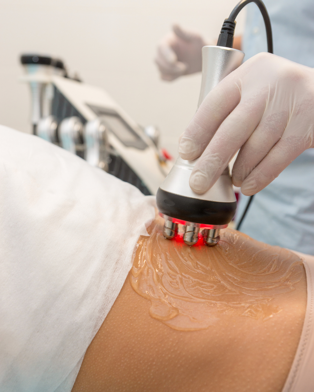 Radio Frequency Skin Tightening