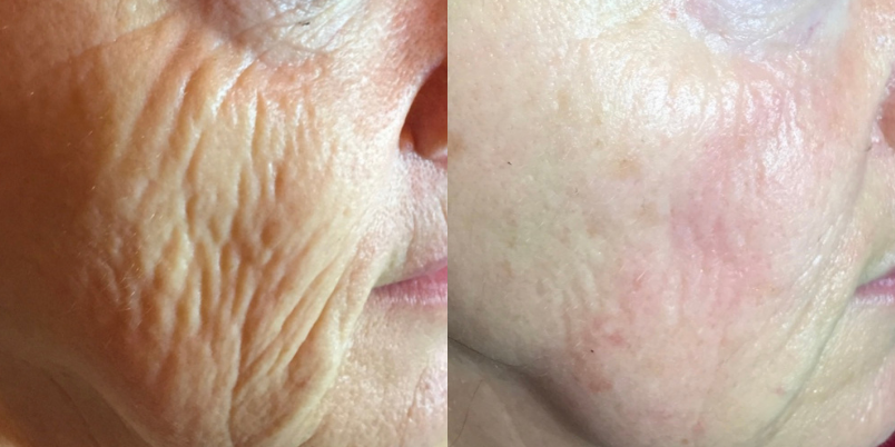 Venu Nova Skin Tightening