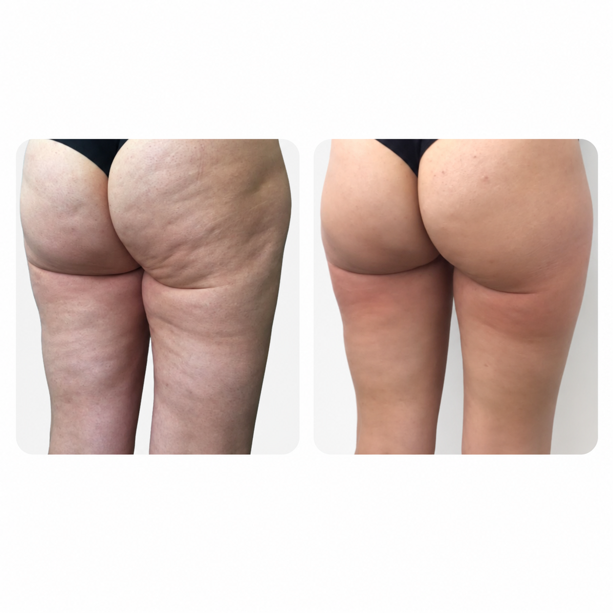 Venus Nova Cellulite 