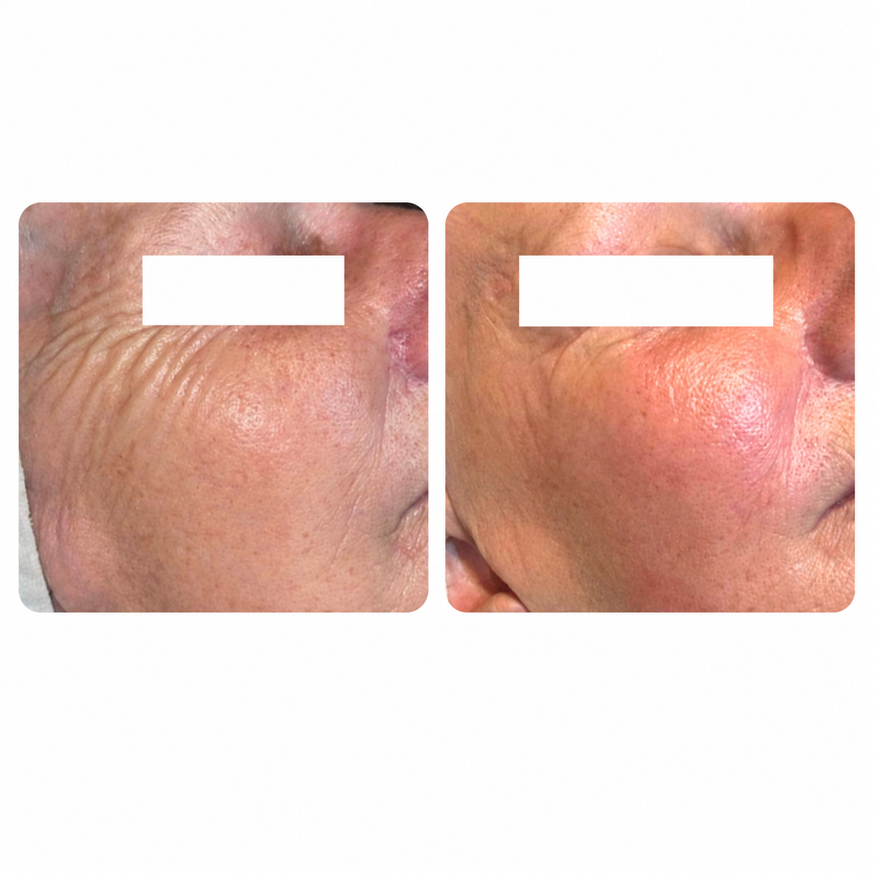 Venu Nova Skin Tightening
