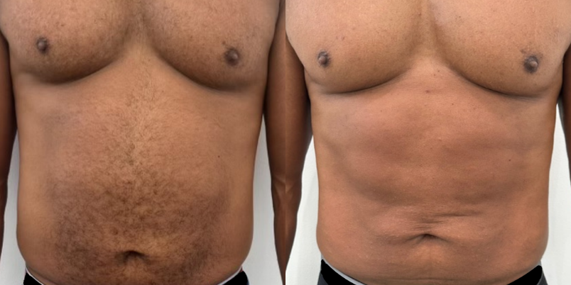 Venus Nova Skin Tightening and EMS
