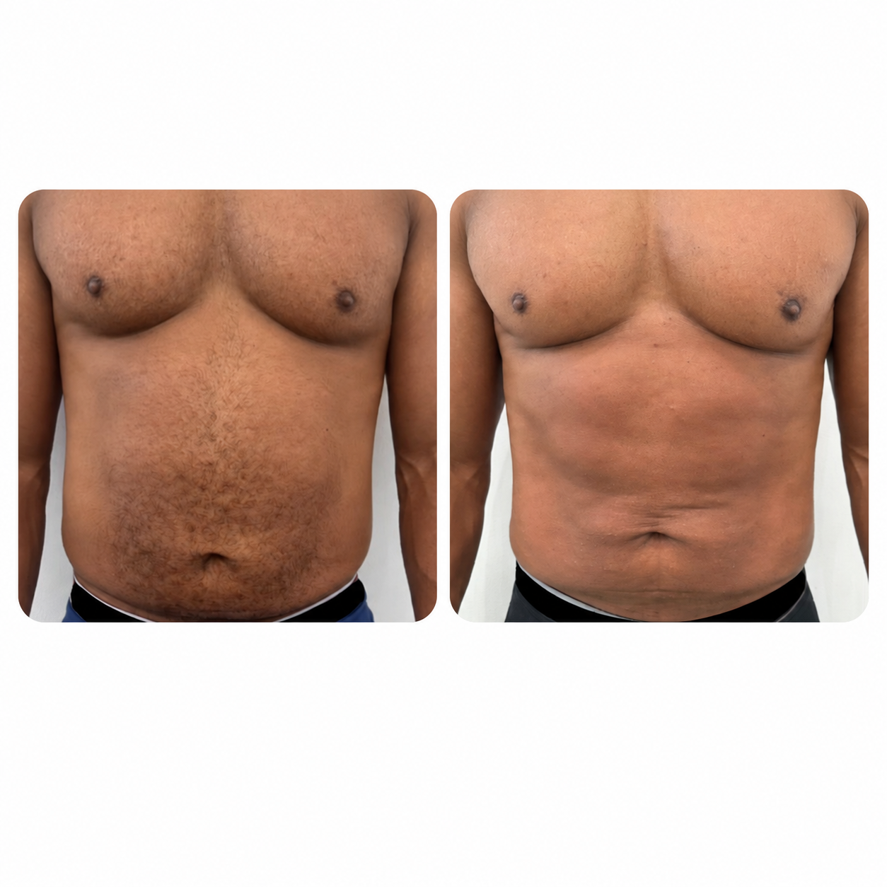 Venus Nova Skin Tightening and EMS