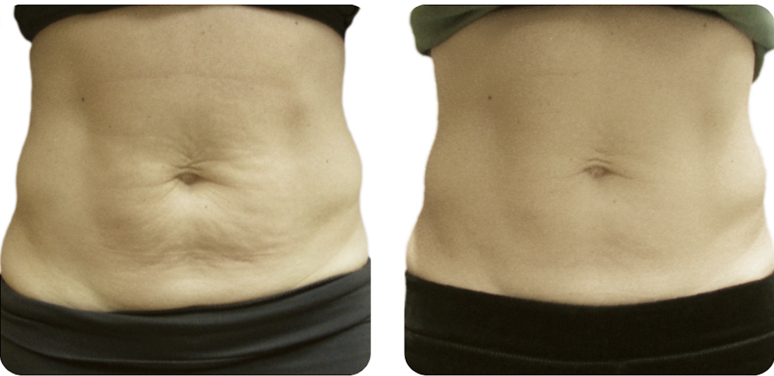 Venus Nova Body Sculpting