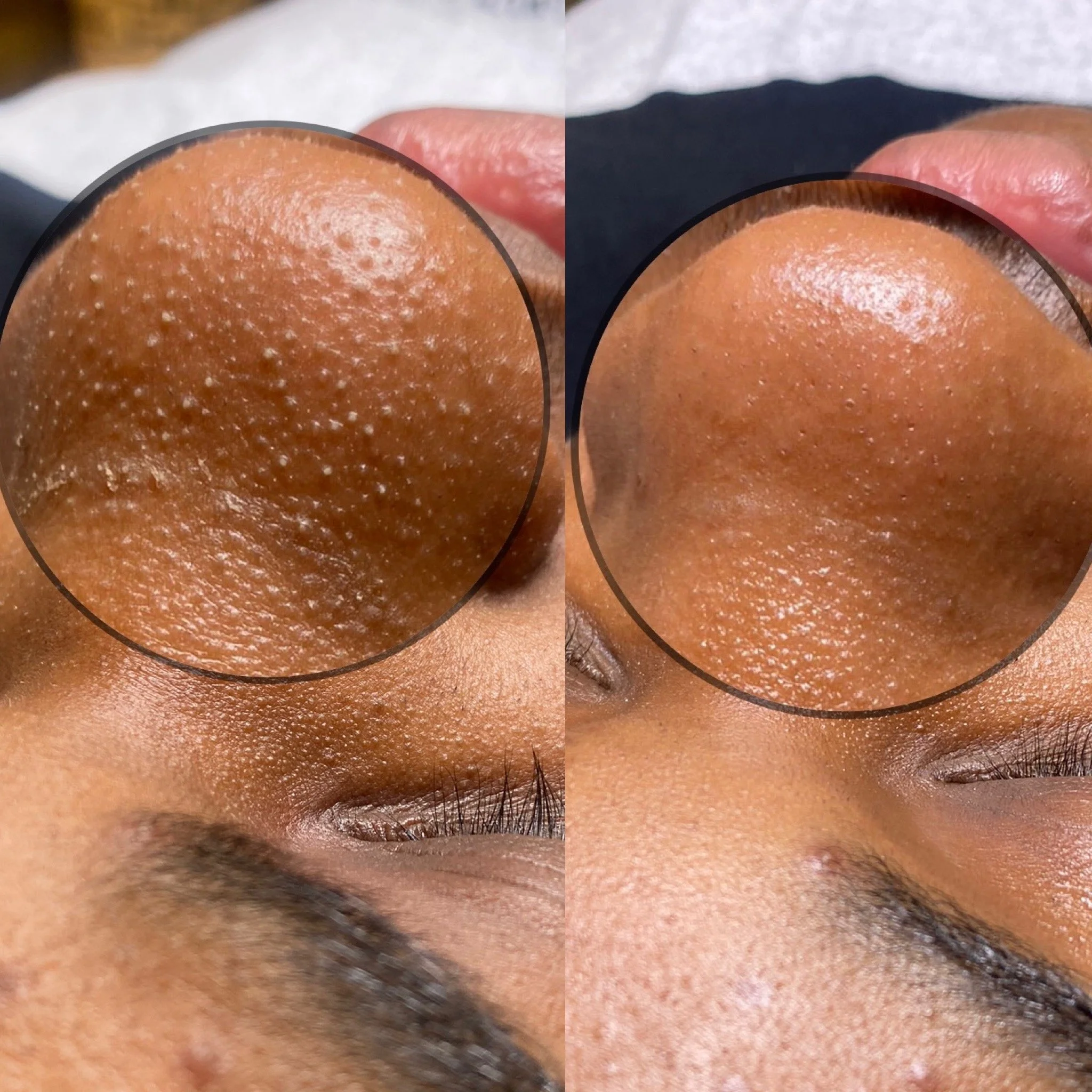 facial extractions at MCH Aesthetics in King of Prussia
