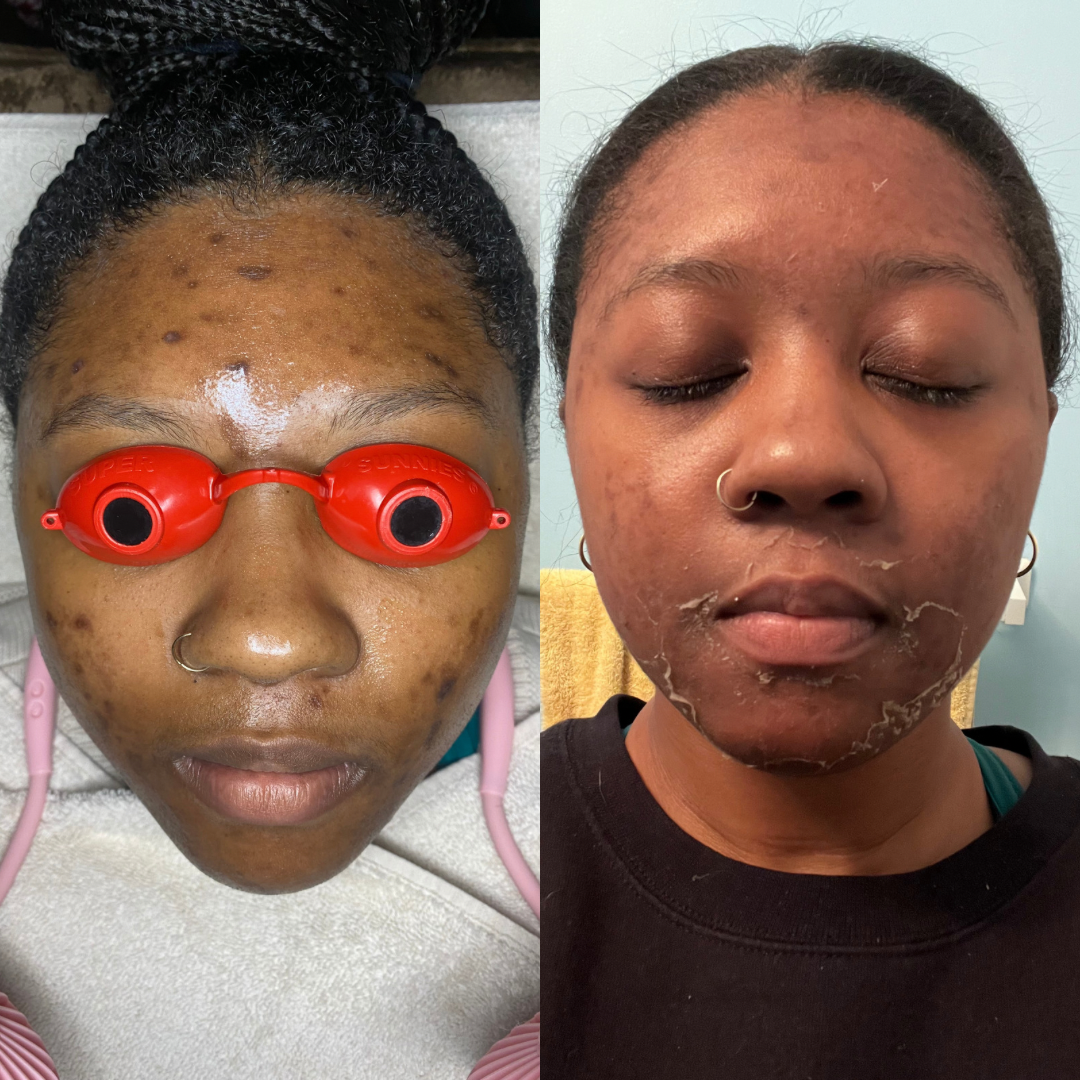 Corrective facial treatment at MCH Aesthetics King of Prussia PA