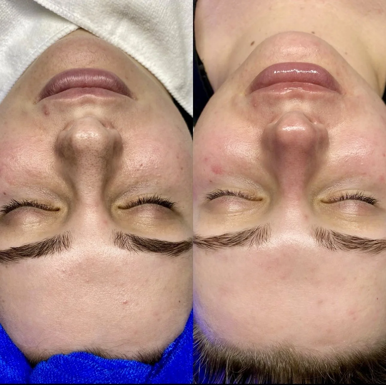 The best Brightening facials at MCH Aesthetics King of prussia