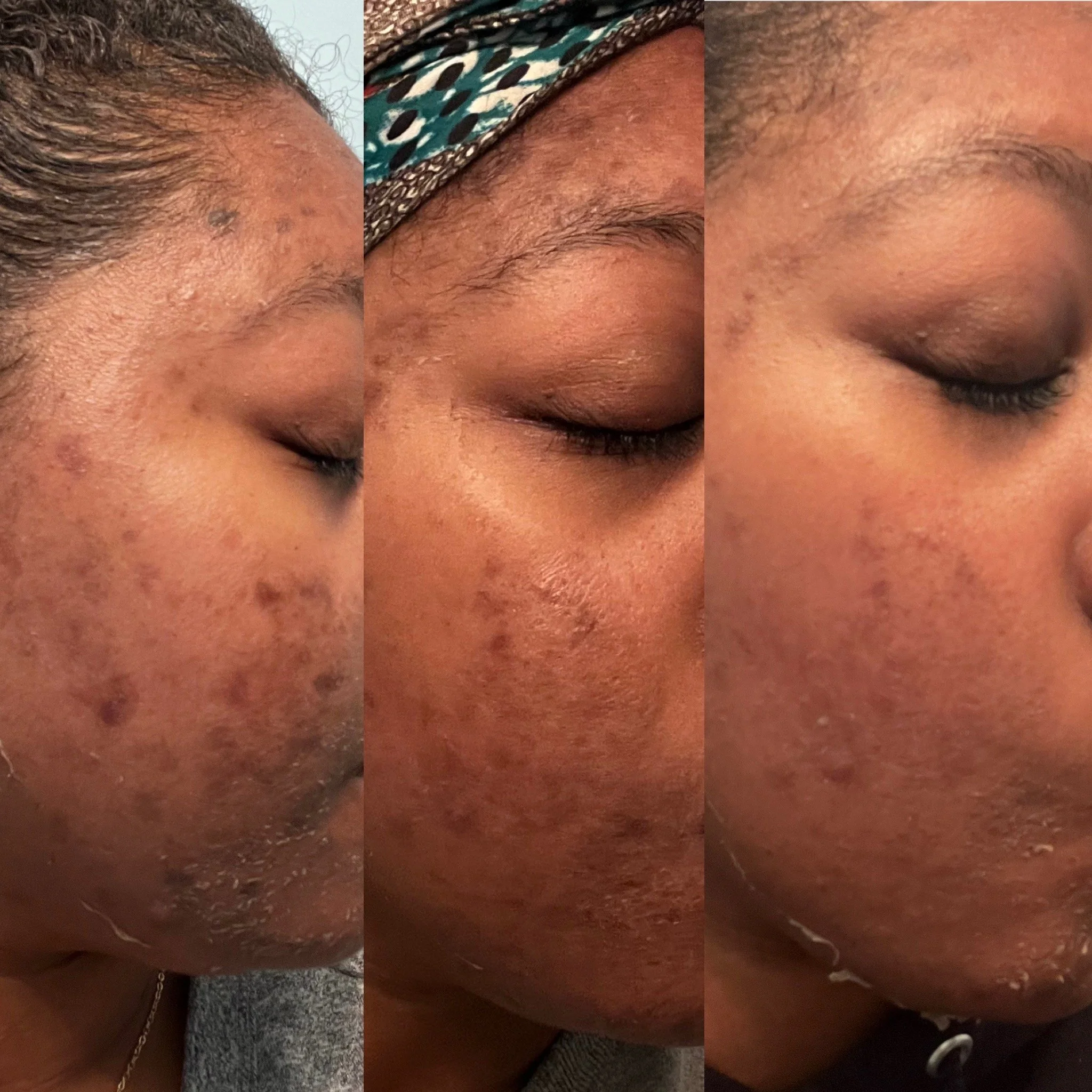 The best chemical peels in philadelphia at MCH Aesthetics