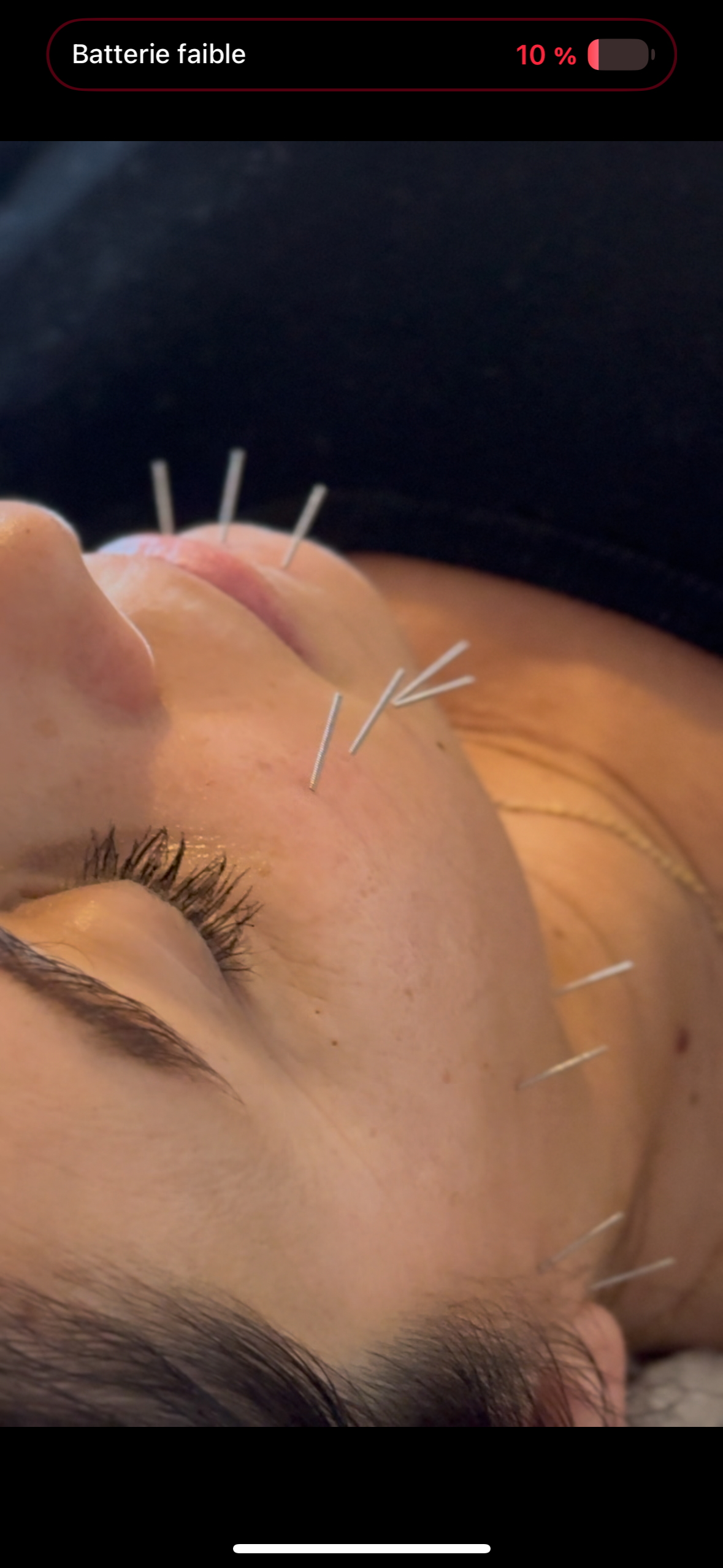 Aculifting
