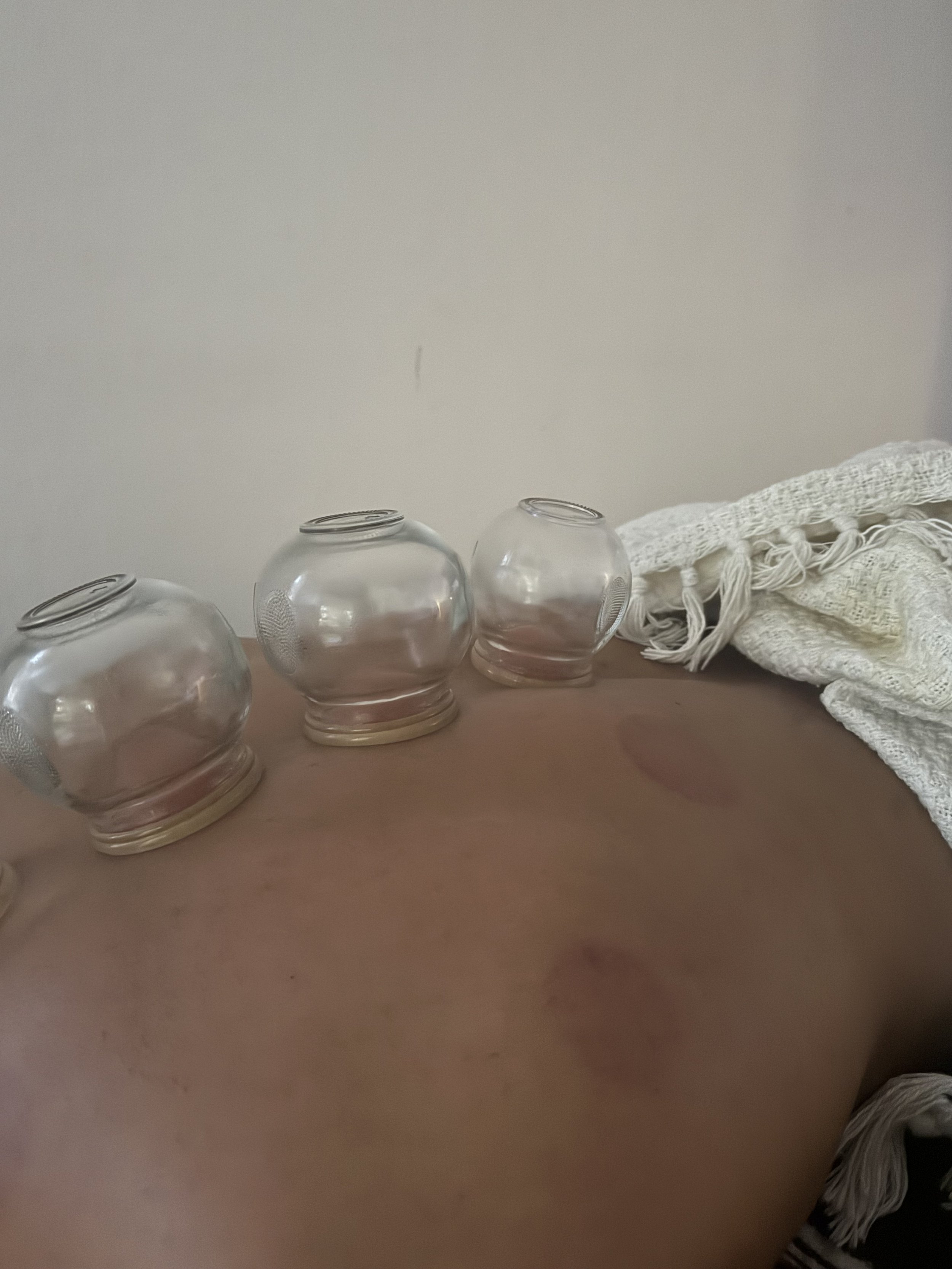 Séance de ventouses chinoises sur le dos, cabinet Femina Shen à Toulouse