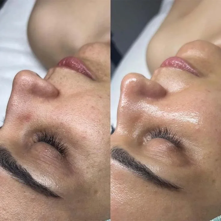 Imagen comparativa antes y después de un procedimiento facial, mostrando mejoras en la piel, incluyendo reducción de poros y mayor brillo.