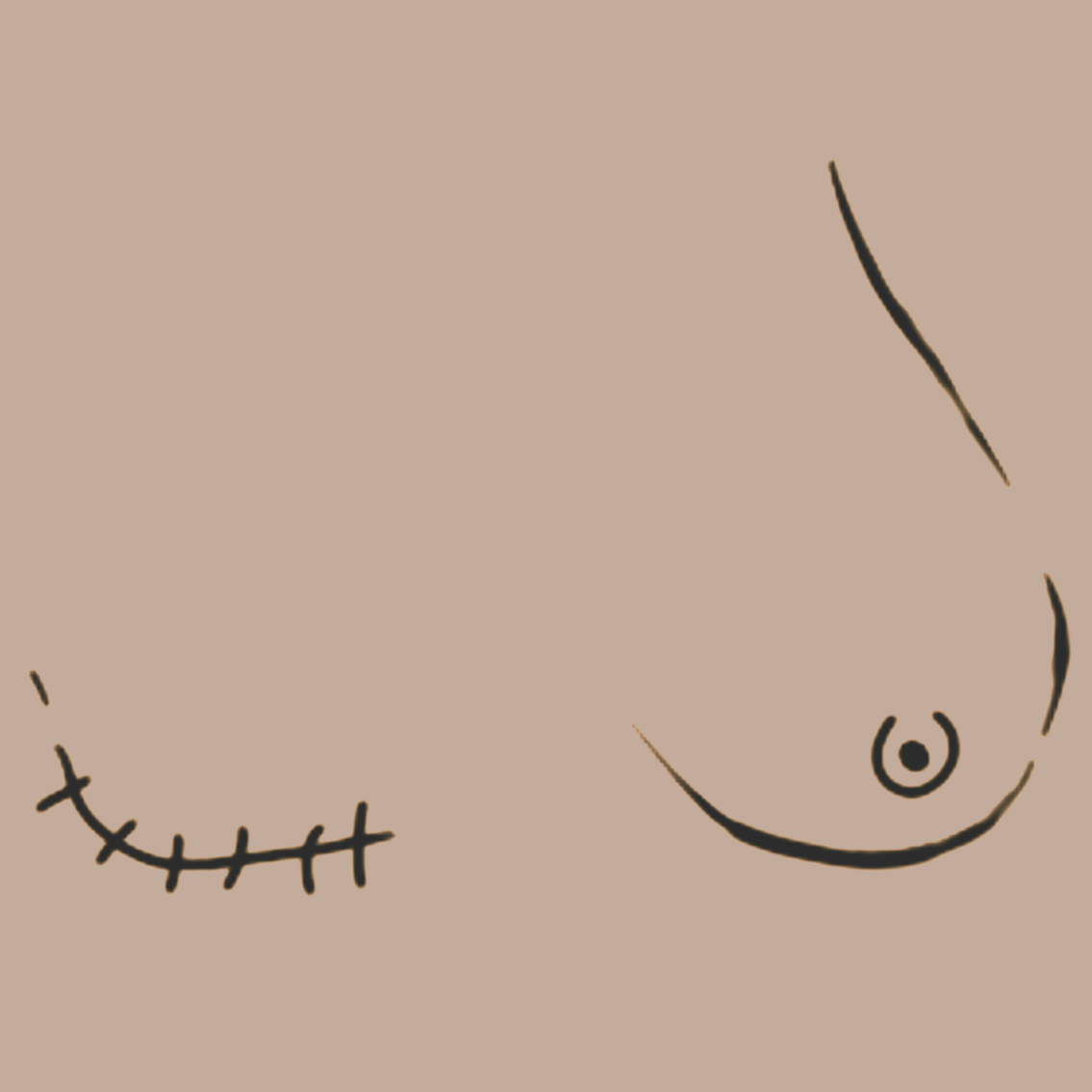 A drawn image of breasts with a mastectomy scar,
