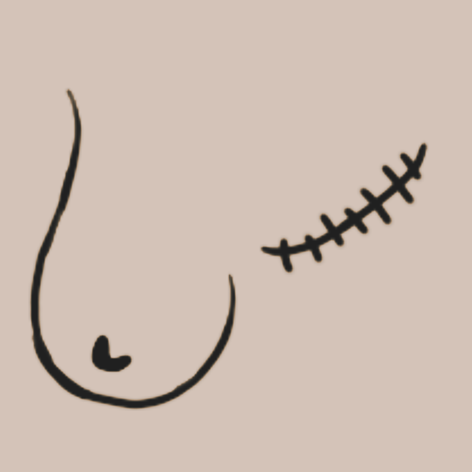 A drawn image of breasts with a mastectomy scar.