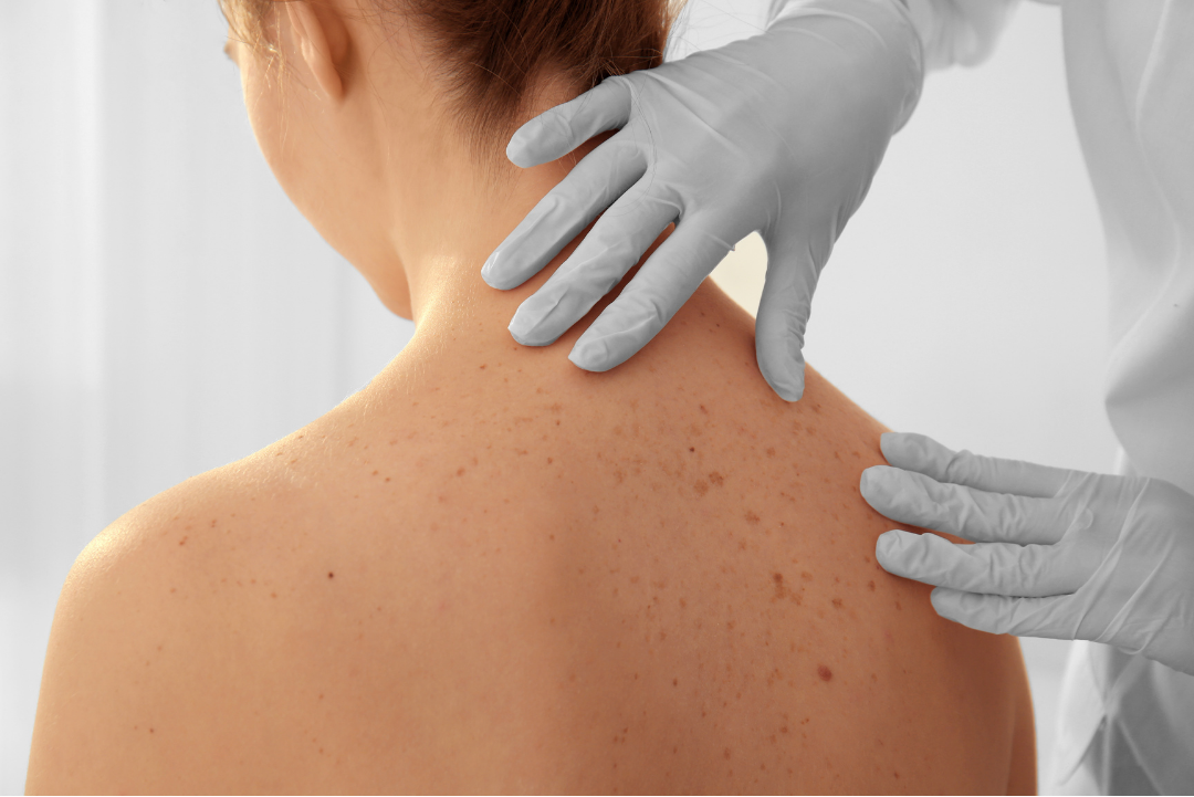 Medical professional examining a patient's back, which has freckled skin.