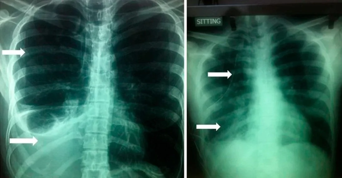 Acupuncture Haemothorax