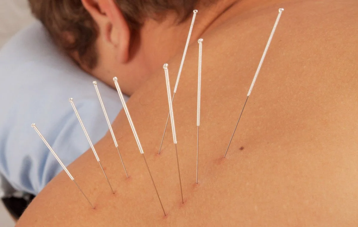 Dry Needling vs Ashi Acupuncture