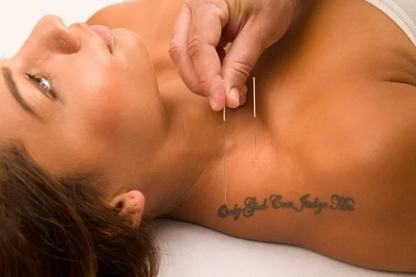 The Two Types Of Acupuncture