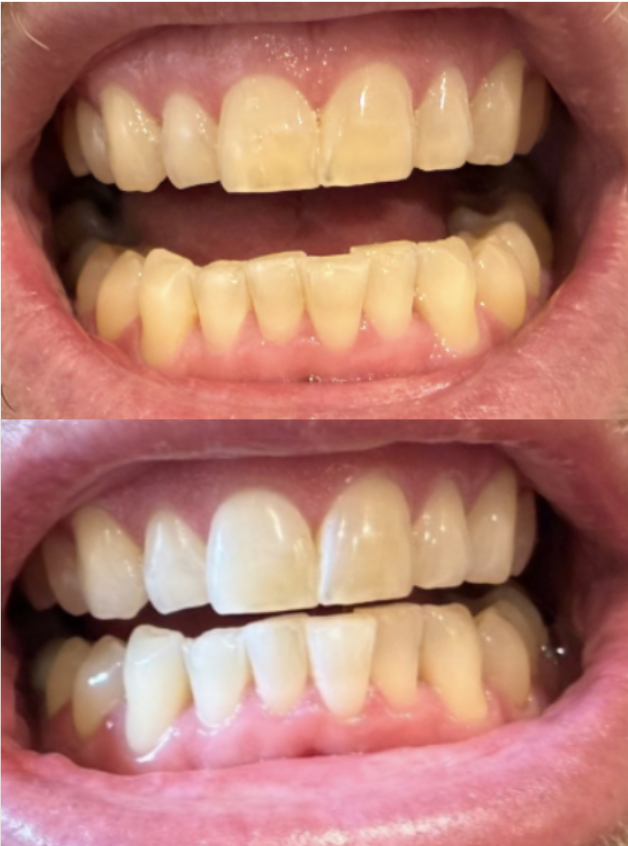 Comparison of teeth before and after dental cleaning or whitening, showing significant improvement in tooth color and cleanliness.